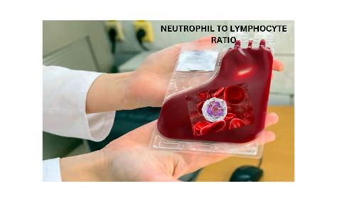 Neutrophil-to-lymphocyte ratio may predict potential complications ...