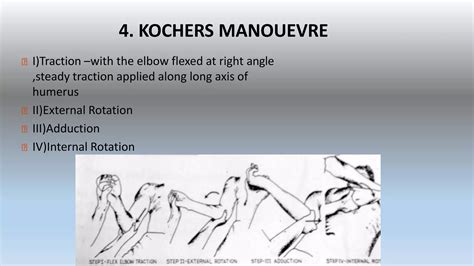 Image result for Shoulder Reduction Methods