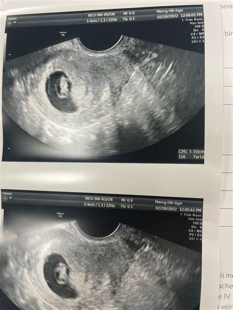 7 Week Ultrasound 2022