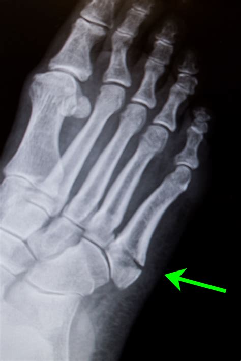 Fractures of the proximal fifth metatarsal: 5th metatarsal fracture ...