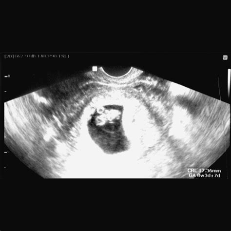 8 Week Ultrasound