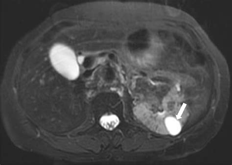 Tuberous Sclerosis Complex (TSC): Renal and Extrarenal Imaging - Academic Radiology
