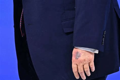 Trump seen with severe hand bruise at Davos