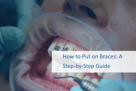 How To Get Rid Of Braces Pain (step-by-step Guide) | TAFT Independent