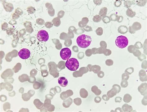 A leucemia mieloide aguda (LMA) é um tipo de câncer no sangue. Exame ...