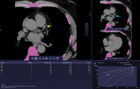 Coronary artery calcium scoring: Its practicality and clinical utility ...