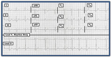 Wandering Atrial Pacemaker Rhythm Strip