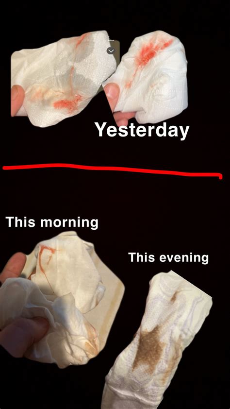 Ovulation Spotting Twins Pictures Of Heavy Implantation Bleeding