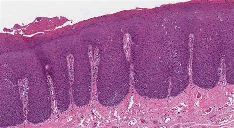 Your pathology report for HPV associated dysplasia of the oral cavity ...
