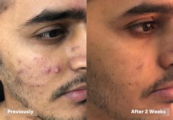 LAURITZ | Unique biotechnology for skin health and beauty