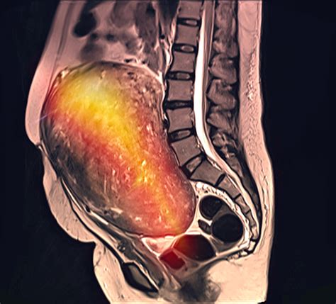 Can Fibroids Cause Lower Back Pain?| Fibroid Lower Back Pain