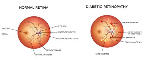 Diabetic Eye Specialists Athens | Diabetes Eye Care Athens, GA