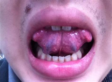 【舌头底下血管发黑图片】舌头底下血管根部粗大发紫发黑是血瘀病吗？_第二人生