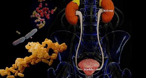 Urinary Tract Infections (UTIs) in Men: Symptoms, Causes, Prevention ...