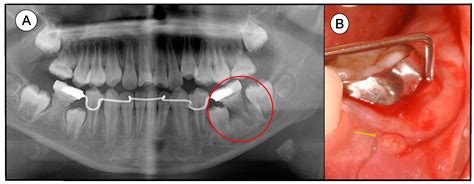 Complications of Teeth Affected by Molar-Incisor Malformation and ...