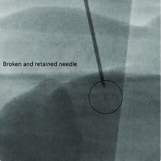 Image result for Locating Needle Decompression Site Using Open Hand as Guide