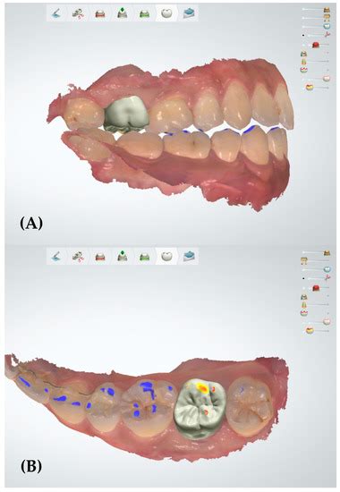 Comparison between Occlusal Errors of Single Posterior Crowns Adjusted ...