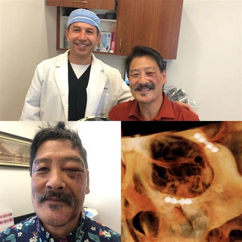 Cheek Bone (Zygoma) Fractures Rancho Santa Margarita CA, Orange County Oral Surgery and Periodontics