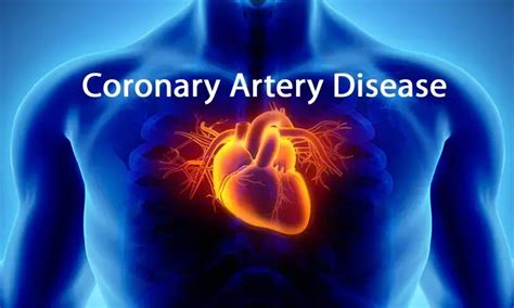 Managing Stable CAD with Type 2 Diabetes: AHA Scientific Statement