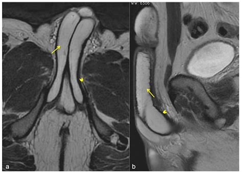 MRI-Cavernosography: A New Diagnostic Tool for Erectile Dysfunction Due to Venous Leakage: A ...
