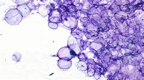 Lipoma vs. Liposarcoma: How to Tell the Difference