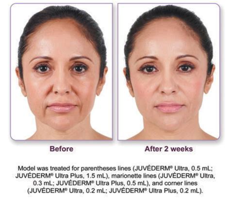 Marionette Lines Fillers Before And After | Thebrokensealblog