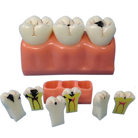 Buy Dental Caries Tooth Model, Pathology Teeth Model Study Teaching ...