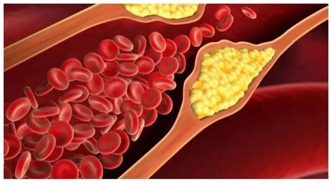 5 supplements that may help lower High Cholesterol