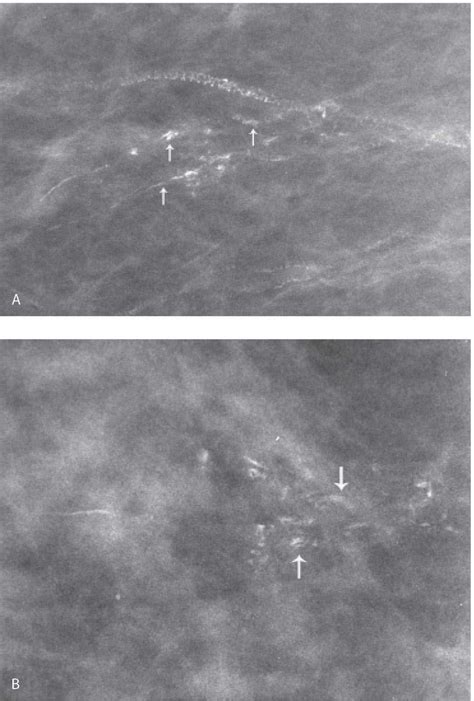 Breast Calcifications | Radiology Key
