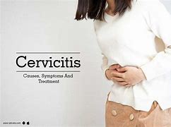 cervicitis 的图像结果