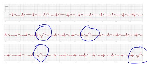 Normal ECG Read Out 的图像结果