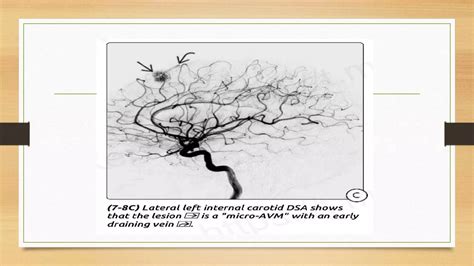 Image result for AVM Brain