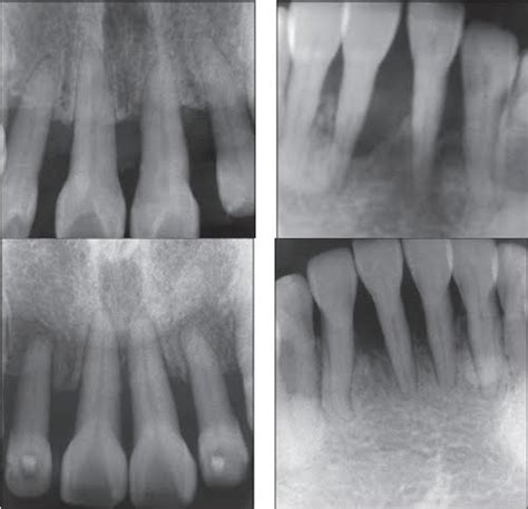 Latest News & Updates in Dentistry: Implant or Endo ? Dentist on UK ...