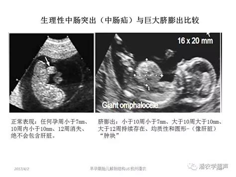 超声检查，胎儿问题_百度宝宝知道-超声检查说胎儿脐带绕颈两周有什么影响吗？