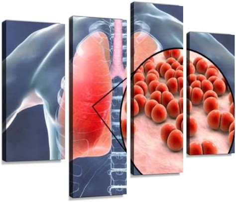 Buy IGOONE 4 Panels Canvas Paintings - Pneumococcal Pneumonia Medical ...