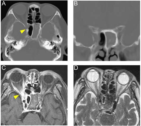 Visual Acuity Impairment from Inflammatory Isolated Sphenoid Sinus ...