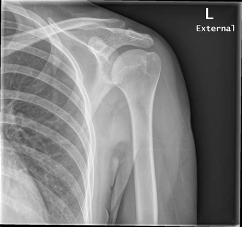What Does A Normal Left Shoulder X Ray Look Like at Ann Sexton blog