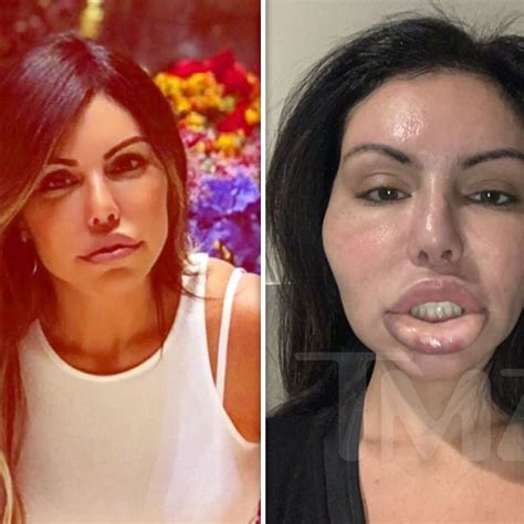 Botched Plastic Surgery