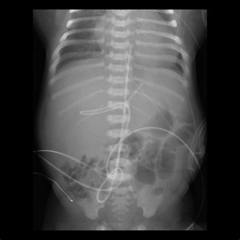 Umbilical Venous Catheter Malfunction / Malposition / Misposition ...