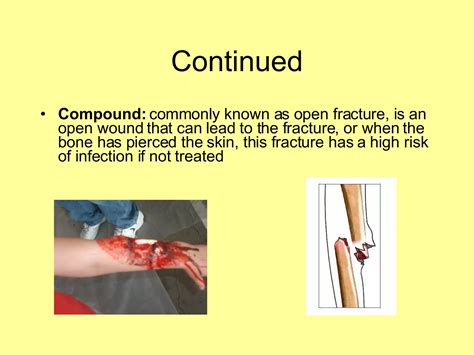 Fractures | PPT