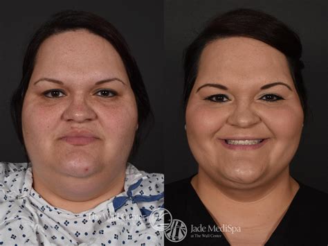 Double Chin Surgery Before And After Pictures