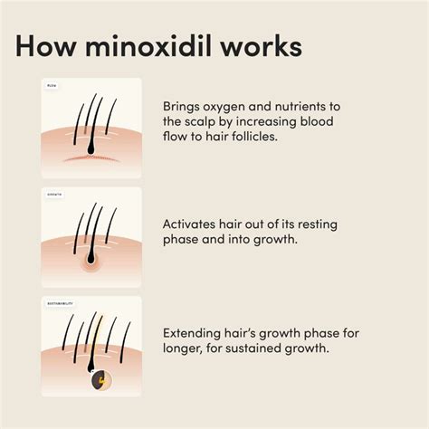 Will Minoxidil Work