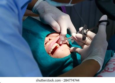 Image result for Tooth Extraction Injection