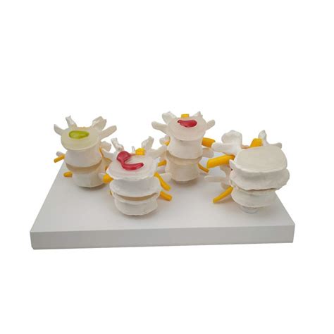 Buy WEDF Educational Model Lumbar Vertebra Spine Diseased Model ...