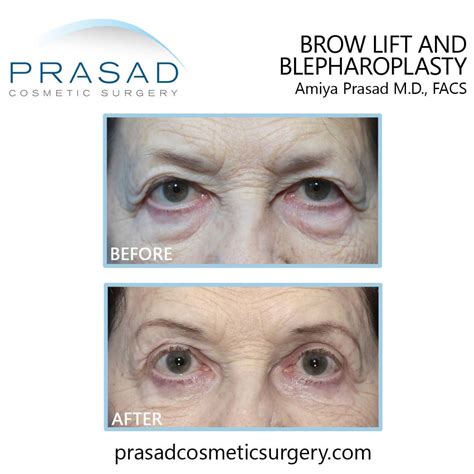 Brow Lift Before and After Photos | Manhattan and Long Island NY