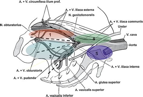 Pelvic Lymph Node Dissection During Robot-assisted Radical Prostatectomy: Efficacy, Limitations ...
