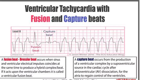 Wide complex tachycardia | PDF