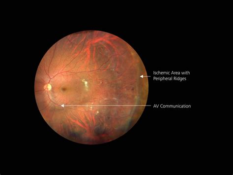 ZEISS CLARUS 700 Case Studies