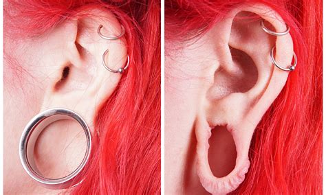 Earlobe Repair, Surgery for Stretched or Split Ear Lobes | Earlobes Reconstruction