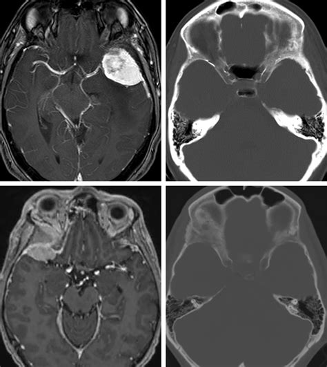 Greater Wing Of Sphenoid Radiograph